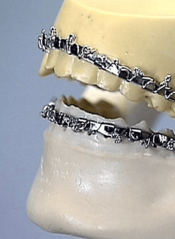 An example of arch bars.